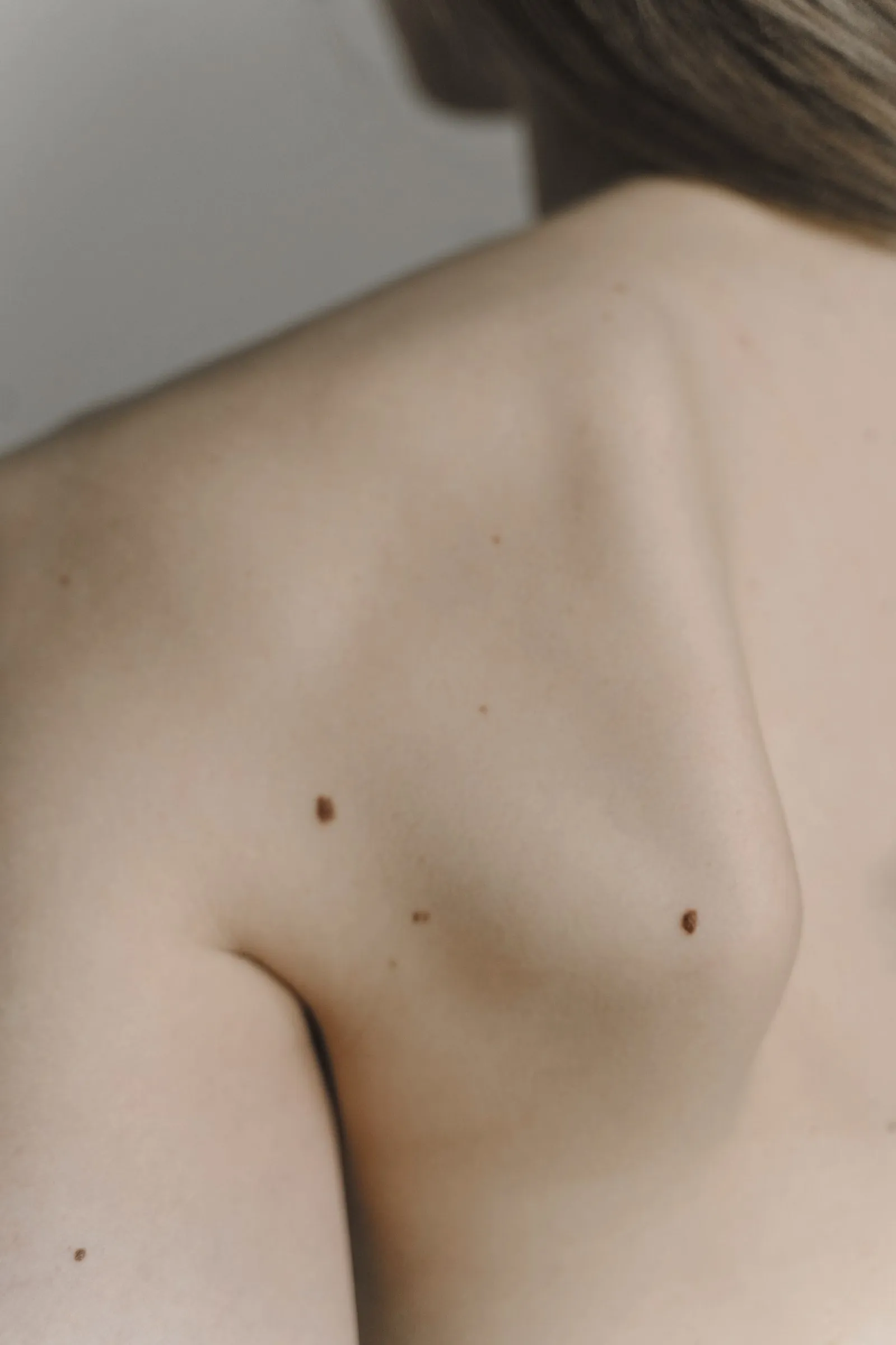 Hombro y espalda de una persona con varios lunares pequeños